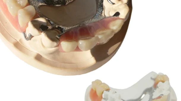 indirect composite prostheses dental laboratory